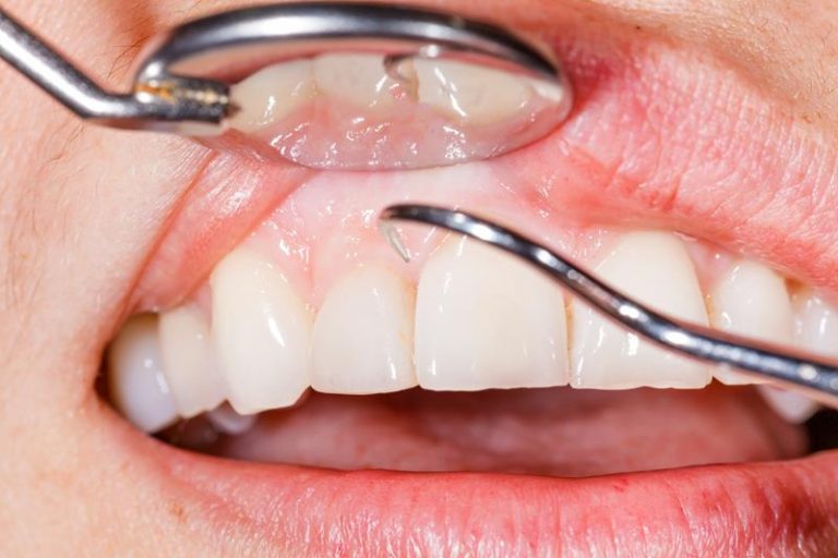 How long does it take for your gums to heal after tooth extraction to